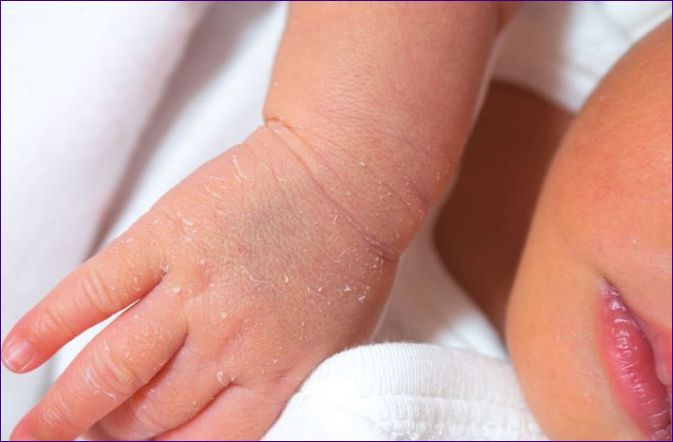 Száraz bőr a babánál: 20 ok és 10 jogorvoslat
