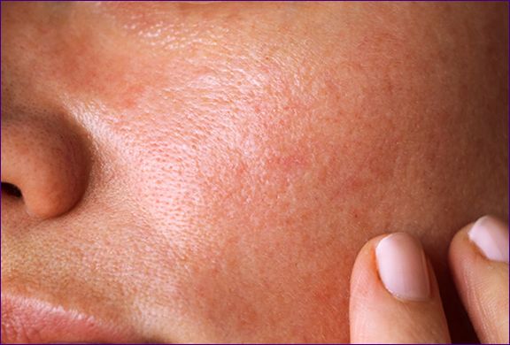 Mit tegyen, ha zsíros az arcbőre: 12 bőrápoló termék és tanácsok